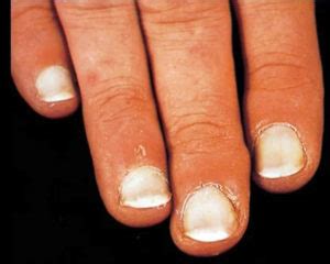 leukonychia definition|causes of koilonychia.